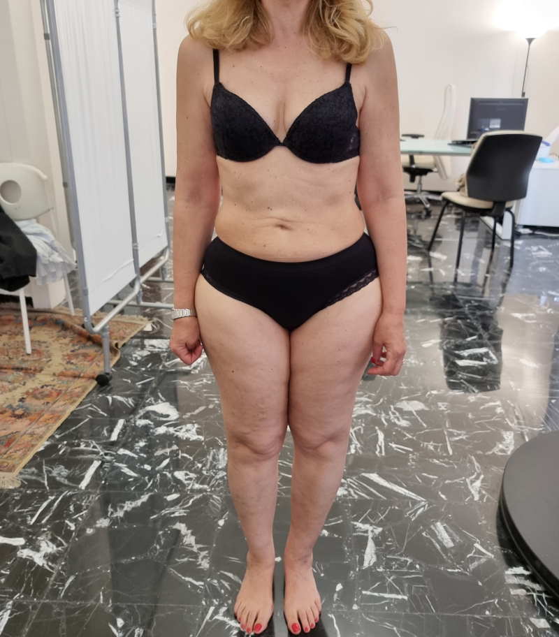 nutrizionista lipedema roma e napoli nutrizionista lipedema roma e napoli