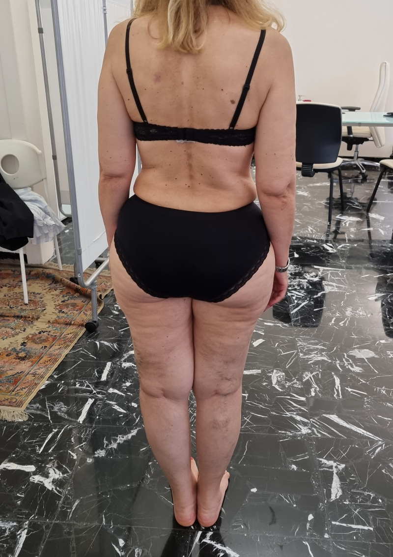 nutrizionista lipedema roma e napoli nutrizionista lipedema roma e napoli