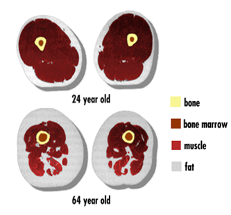 Sarcopenia